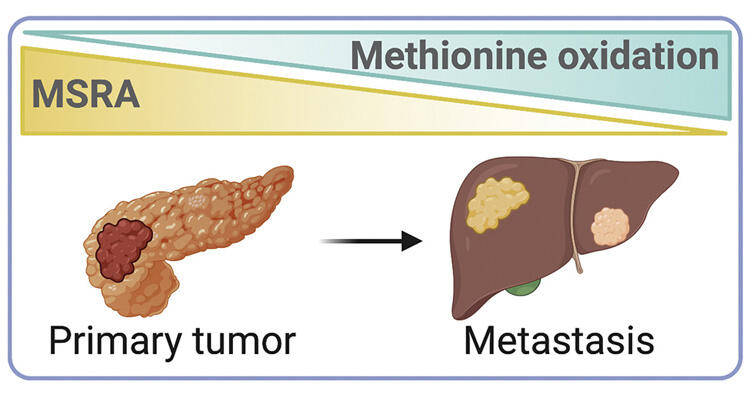 Illustration of Healthy pancreas (left) and metastatic tumors on the liver (right) 